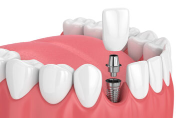 Dental Implants