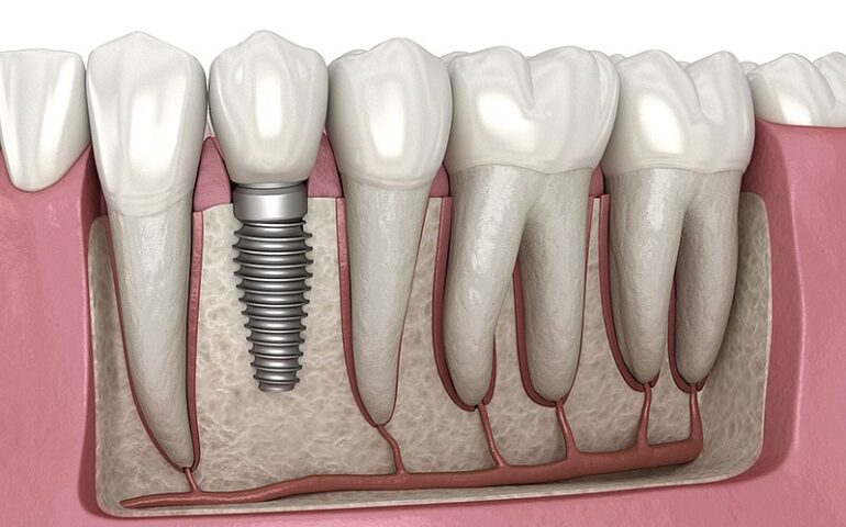 Dental-implant-illustration