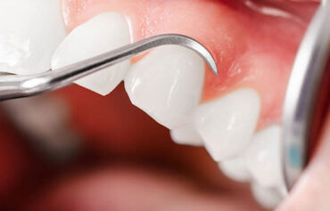 Periodontal Therapy