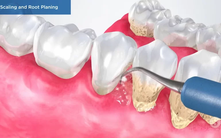 Periodontal Therapy