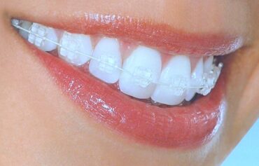 Ceramic/ Tooth colored orthodontic Braces