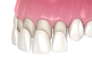 Dental veneers