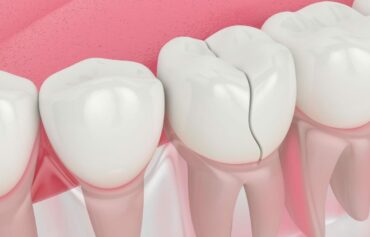 Fractured teeth restoration