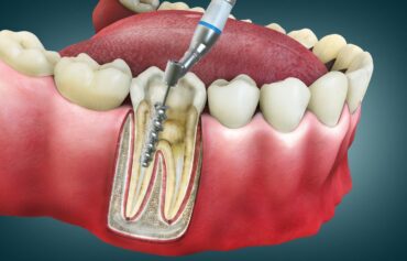 Root Canal Treatment