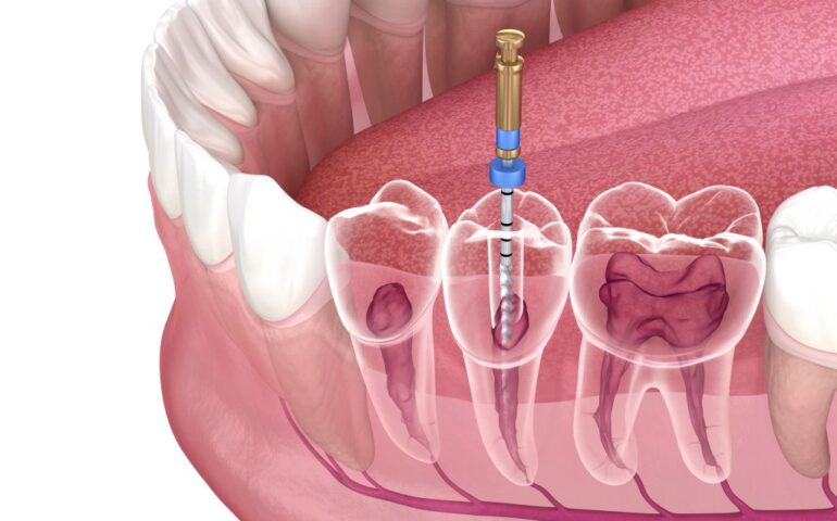 Root Canal Treatment